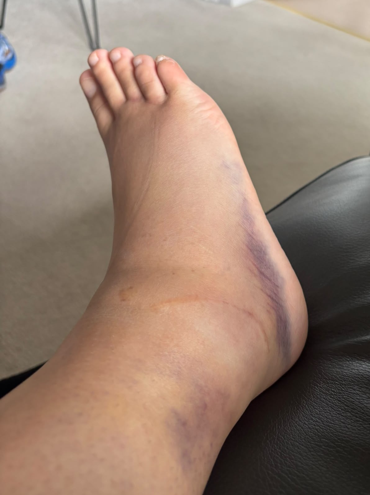 Assessment of a recovering ankle injury